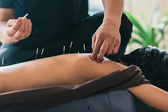 Acupuncture